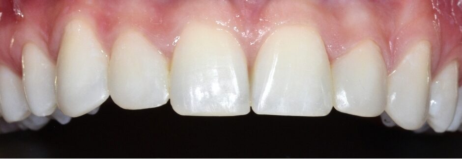 Gydytojo odontologo, estetinių restauracijų specialistės, Odetos Bardijevskienės atvejis po