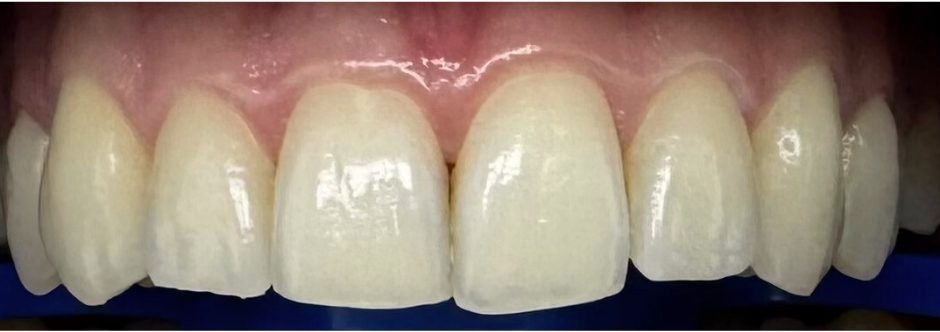 Burnos higienistės Radvilės Maksimavičiūtės dantų balinimo Philips ZOOM sistema atvejis prieš