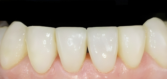 Gydytojo odontologo, estetinių restauracijų specialistės, Odetos Bardijevskienės atvejis po