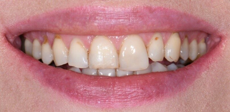 Gydytojo odontologo, estetinių restauracijų specialisto, Žilvino Budrevičiaus atvejis prieš