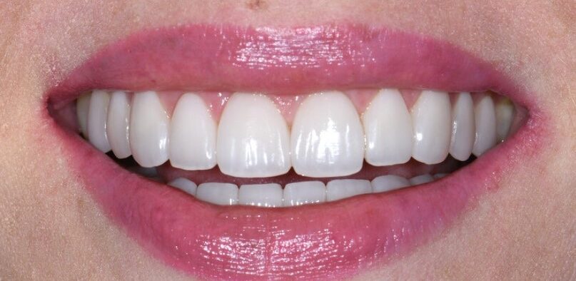 Gydytojo odontologo, estetinių restauracijų specialisto, Žilvino Budrevičiaus atvejis po