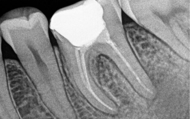 Gydytojo endodontologo Pedram Hosseinzadehfard dantų šaknų kanalų pergydymo atvejis prieš