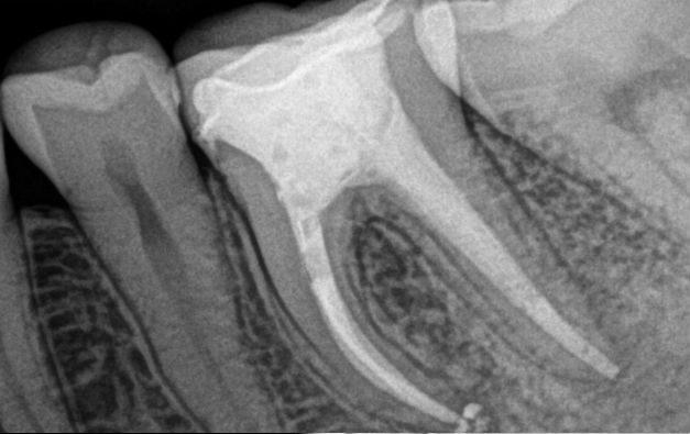 Gydytojo endodontologo Pedram Hosseinzadehfard dantų šaknų kanalų pergydymo atvejis po