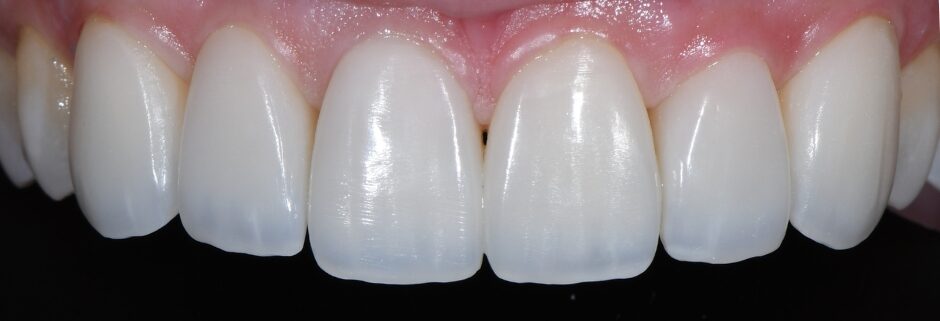 Gydytojo odontologo, estetinių restauracijų specialisto, Žilvino Budrevičiaus atvejis po