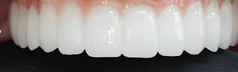 Gydytojos odontologės ortopedės Rūtos Krušinskaitės „All on 6” atvejis po