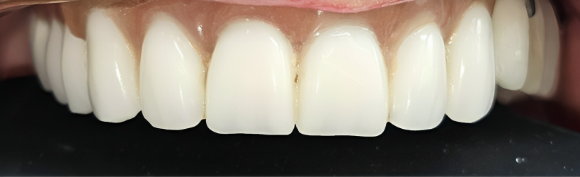 Gydytojos odontologės ortopedės Rūtos Krušinskaitės „All on 6” atvejis prieš