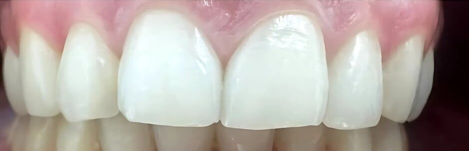 Gydytojos ortodontės Ievos Laktionkinienės ortodontinio gydymo atvejis po