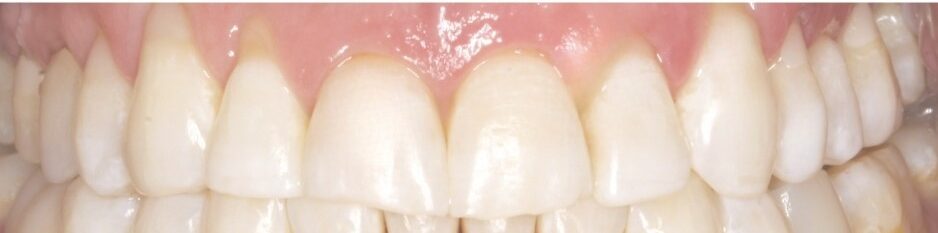 Burnos higienistės Žibuoklės Buinevičiūtės dantų balinimo Philips ZOOM sistema atvejis po