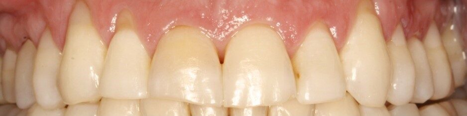 Burnos higienistės Žibuoklės Buinevičiūtės dantų balinimo Philips ZOOM sistema atvejis prieš